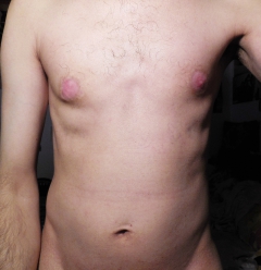 My tits in pain (nipples removed) - N